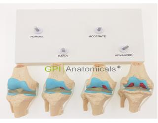 GPI/A11120 4階段膝關節模型
